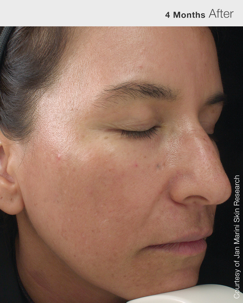 luminate_face_lotion_1053S03_After