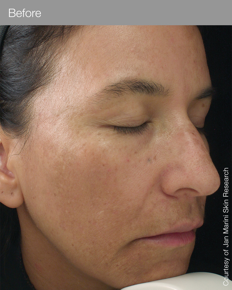luminate_face_lotion_1053S03_Before